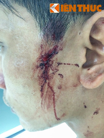 Anh Thịnh bị Phan Cao Sơn dùng đèn pin đánh gây rách vùng da ở đầu và mặt.