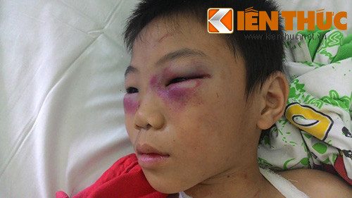 Nhìn những vết thương vết thương mà bé Hiếu phải gánh chịu khiến không ít người phải xót xa và căm phẫn người cha dượng tàn ác. Nhìn những vết thương vết thương mà bé Hiếu phải gánh chịu khiến không ít người phải xót xa và căm phẫn người cha dượng tàn ác.