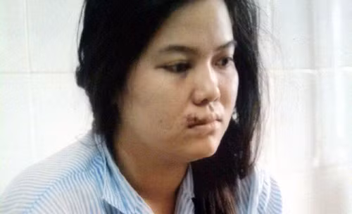 Chị Lan bị đánh rách môi, phải vá 5 mũi, đang điều trị tại bệnh viện.