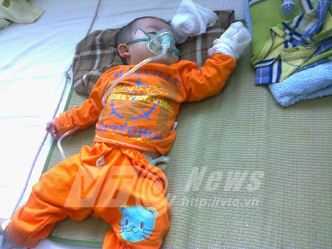 Cháu bé bị sởi nặng kèm viêm phổi đang điều trị tại BV Nhi. Ảnh Nguyễn Tâm.