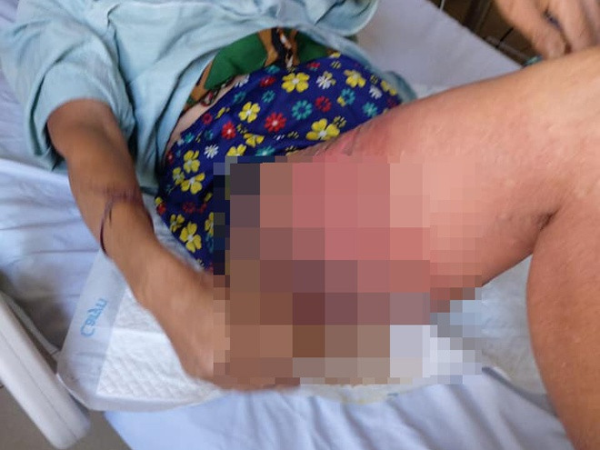 Nguoi phu nu suyt mat mang vi dap gung vao vet thuong