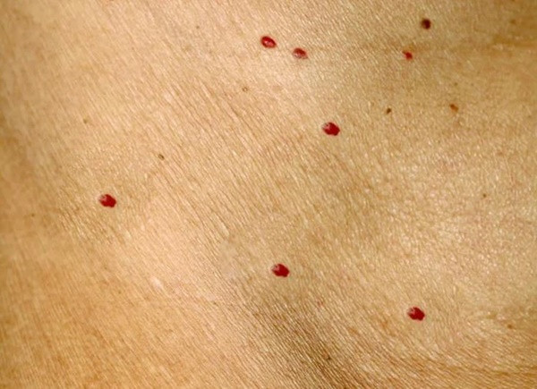 4 bat thuong tren da xuat hien can de phong ung thu gan-Hinh-3