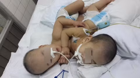 Hai cháu bé song sinh bị dính liền trước khi ca phẫu thuật diễn ra