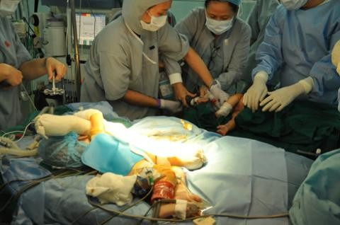 Các bác sĩ Bệnh viện Nhi Đồng 2 mổ tách cặp song sinh gái 4 tháng tuổi cuối năm 2012. Ảnh: Internet.