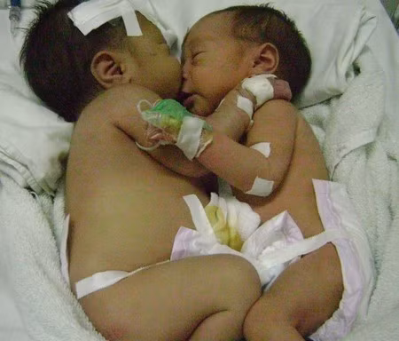 Cặp song sinh Cu- Cò đã được tách dính thành công. Ảnh: Internet.