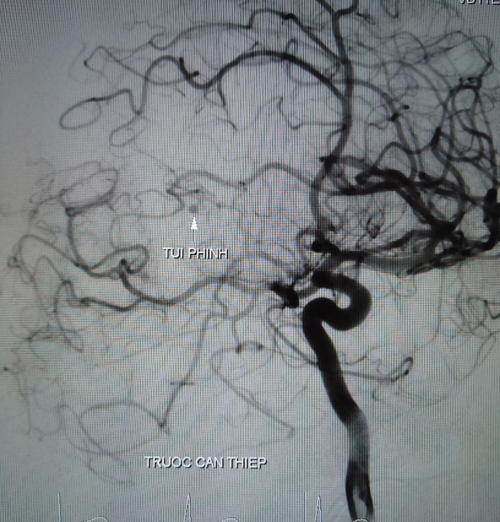 Thanh nien 27 tuoi nguy kich do dot quy sau con dau dau du doi