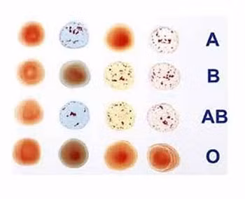 Nhóm máu liên quan đến bệnh ung thư.