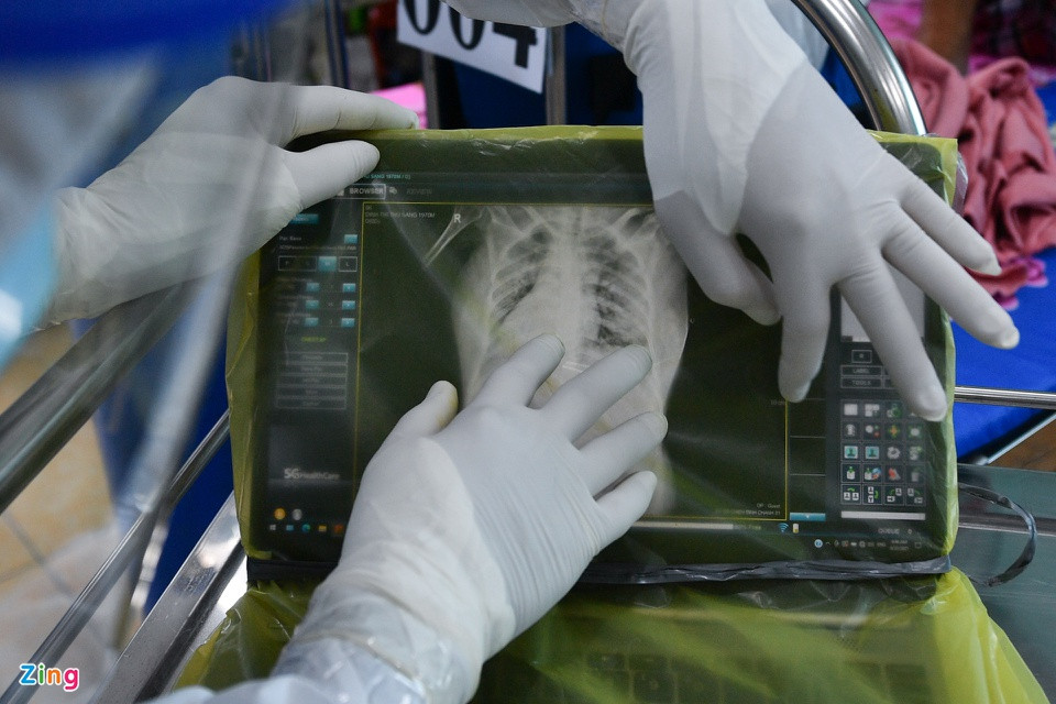 br/> Hình ảnh X-quang phổi của một bệnh nhân COVID-19 nặng đang nằm tại khu cấp cứu. Phổi trắng đục và đông đặc, không thể nhìn rõ 2 lá phổi nguyên vẹn.