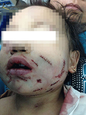 Khuôn mặt cháu bé sau khi được khâu. (Ảnh: BV Nhi đồng 1)