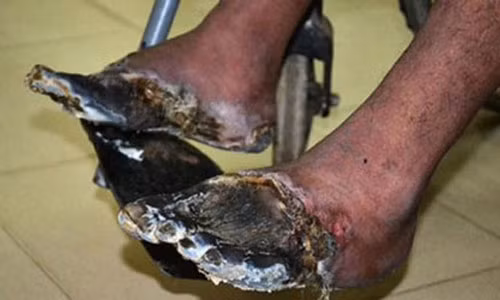 Người sống bị chết khô 2 chân vì hút nhiều thuốc lá.