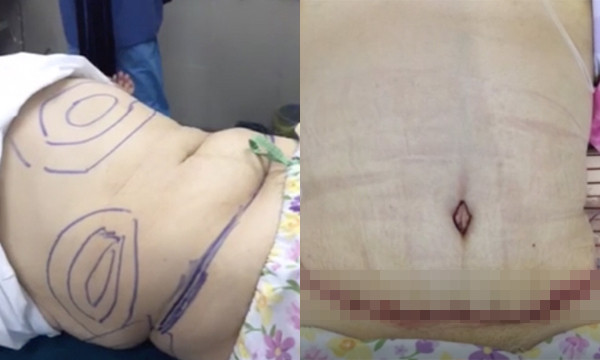 Quy trình tạo hình thành bụng