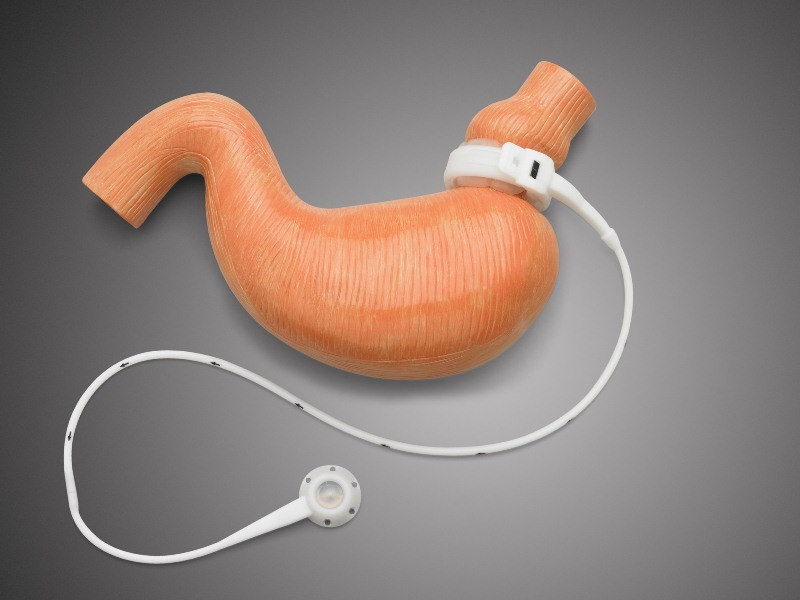 Phương pháp thắt đai dạ dày để giảm cân