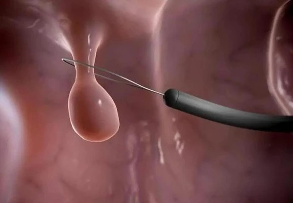 Khi ung thu ruot xuat hien co the se co 3 nhieu, 2 dau-Hinh-3