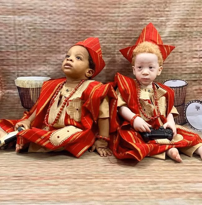 Hai bé sinh đôi có nét mặt và các đặc điểm khuôn mặt giống nhau nhưng lại khác ở màu da và máu tóc. Daniel chào đời trước David vài phút. Bé có màu da đen, tóc đen và xoăn y hệt như bố mẹ và chị gái 4 tuổi. Trong khi đó, David lại có da trắng, tóc vàng.