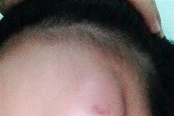 8. Trán sưng: Phần trán của bạn bị sưng không phải do va đập cũng là một dấu hiệu không mấy may mắn.