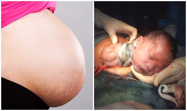 Thói quen của mẹ bầu dễ khiến thai nhi bị dây rốn quấn cổ Thoi quen cua me bau de khien thai nhi bi day ron quan co