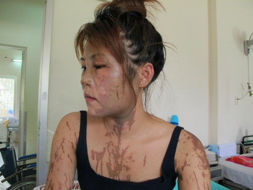 Chị Châu với gương mặt bị tạt axit.