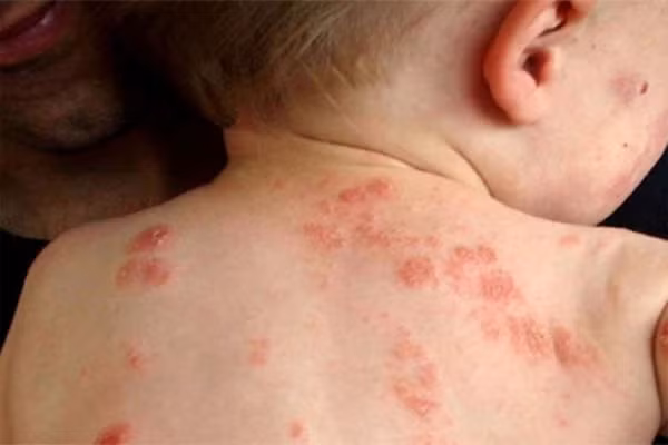 Eczema còn gọi là chàm. Là tình trạng da ngứa, đỏ, khô và nứt. Thường xảy ra ở những vùng có nếp gấp như sau đầu gối hoặc trong của khuỷu tay. Với hiện tượng này, bạn nên tăng cường tiêu thụ các chất béo trong các loại hạt và dầu cá.
