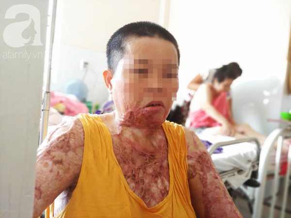 Nguoi phu nu bi tinh cu tat axit bong nang khi niu keo