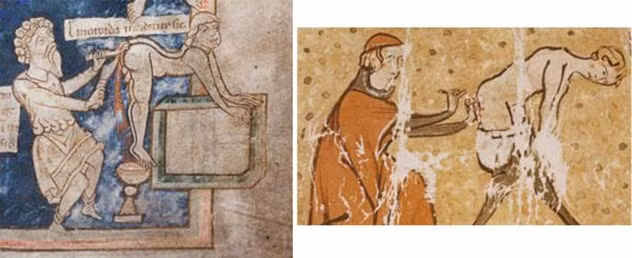 Vào thời Trung cổ, những bệnh nhân mắc bệnh trĩ thường được điều trị bằng cách đưa một que sắt nóng đỏ vào hậu môn nhằm ngăn chặn thịt thừa lồi ra ngoài. Phương pháp điều trị rùng rợn này thường gây đau đớn, bỏng rát ở bộ phận này.