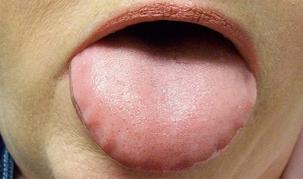 Vào những năm 1800, những người bị nói lắp sẽ được điều trị bằng cách cắt lưỡi. Tuy nhiên, nhiều bệnh nhân đã mất mạng do mất máu quá nhiều.