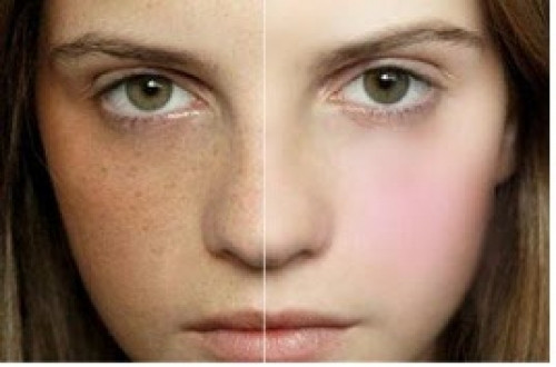 Loại bỏ tàn nhang. Ngâm lòng đỏ trứng trong một chén rượu trong vòng 1 tuần. Sau đó lấy ra nghiền kỹ hỗn hợp và dùng để đắp mặt mỗi ngày. Thời gian đắp chừng 1 tiếng và rửa lại với nước ấm.