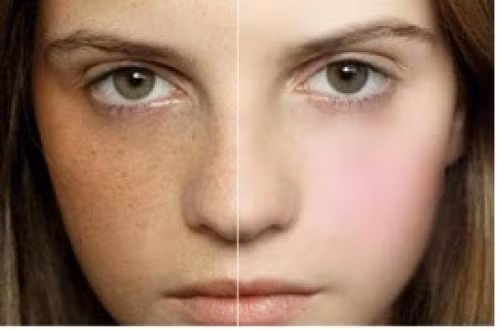 Loại bỏ tàn nhang. Ngâm lòng đỏ trứng trong một chén rượu trong vòng 1 tuần. Sau đó lấy ra nghiền kỹ hỗn hợp và dùng để đắp mặt mỗi ngày. Thời gian đắp chừng 1 tiếng và rửa lại với nước ấm.