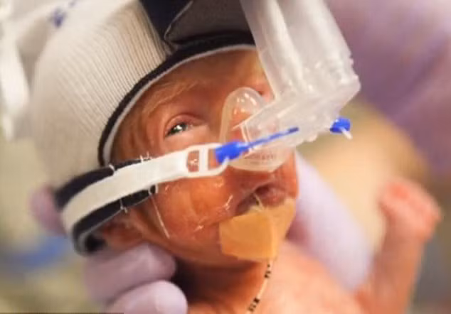 Đến ngày thứ 5 sau sinh ra bé Walker đã phải đeo ống thở.