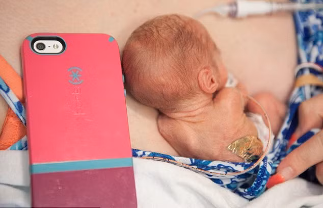 Little Adilynn chỉ nặng 0,4 kg khi sinh ra, cơ thể bé còn nhỏ hơn một chiếc điện thoại iphone.