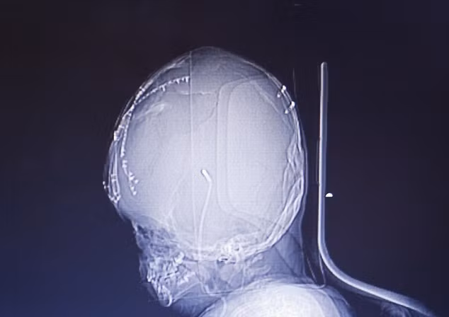 Tuy cô bé đang phục hồi với một tốc độ đáng ngạc nhiên nhưng với việc hộp sọ bị biến dạng do não úng thủy, bộ não của Roona chắc chắn sẽ chịu nhiều thiệt hại. Câu chuyện của Roona đã gây xúc động cho các bác sĩ và các tổ chức y tế, từ thiện. Hiện cô bé đã được điều trị miễn phí.