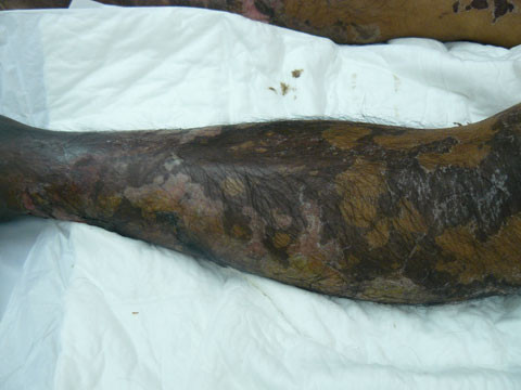 Tại bệnh viện, bác sĩ cho biết ông T., bị viêm màng não do liên cầu khuẩn lợn, tình hình rất nguy kịch. Liên cầu khuẩn lợn mà ông T mắc phải được xác định do chính bát tiết canh dê mà ông đã ăn hai ngày trước đó. Theo bật mí của một cựu chủ quán bán tiết canh dê thì, phần cuống họng dê nhỏ nên nhiều khi phải dùng sụn, họng lợn để băm, pha vào cùng với tiết dê. Mà phần họng lợn là nơi khu trú của liên cầu khuẩn. Điều này lý giải tại sao có người ăn tiết canh dê vẫn mắc liên cầu khuẩn lợn.