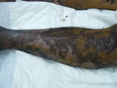 Tại bệnh viện, bác sĩ cho biết ông T., bị viêm màng não do liên cầu khuẩn lợn, tình hình rất nguy kịch. Liên cầu khuẩn lợn mà ông T mắc phải được xác định do chính bát tiết canh dê mà ông đã ăn hai ngày trước đó. Theo bật mí của một cựu chủ quán bán tiết canh dê thì, phần cuống họng dê nhỏ nên nhiều khi phải dùng sụn, họng lợn để băm, pha vào cùng với tiết dê. Mà phần họng lợn là nơi khu trú của liên cầu khuẩn. Điều này lý giải tại sao có người ăn tiết canh dê vẫn mắc liên cầu khuẩn lợn.