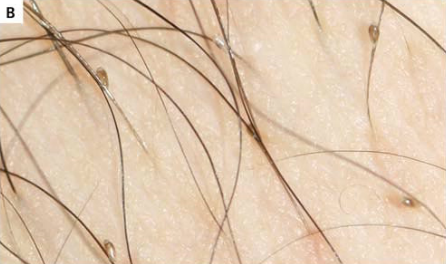 Người nhiễm bệnh thường bị ngứa nhiều ở khu vực lông mu nhất là những vùng nhạy cảm của con người. Bệnh này ảnh hưởng đến khoảng 2% dân số toàn thế giới. Bệnh rận mu tuy do loài rận ký sinh nhưng được xếp vào nhóm các bệnh lây truyền qua đường tình dục.