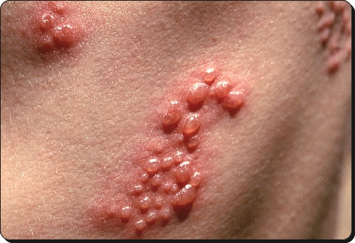 Ban đỏ. Khi rận mu cắn thường sẽ có những lỗ nhỏ (mắt thường không nhìn thấy), xung quanh lỗ cắn đỏ, xuất hiện nốt ban đỏ, lỗ cắn đó sau 5 ngày sẽ có phản ứng dị ứng và nổi lên dạng mụn đỏ. Do bệnh nhân dùng tay gãi nên thường lây lan sang diện rộng, có các mụn mủ, mụn nước.