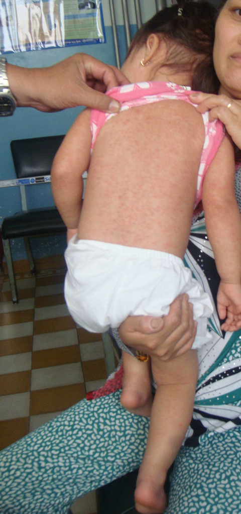 Trẻ bị sởi điều trị ở Bệnh viện Nhi đồng 2 TPHCM.