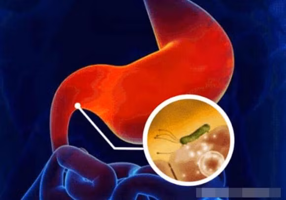 Canh giac voi 5 dau hieu tu benh da day den ung thu