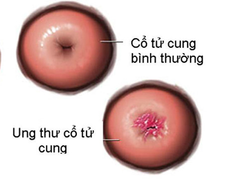 Virus HPV là thủ phạm chính gây ung thư cổ tử cung ở phụ nữ