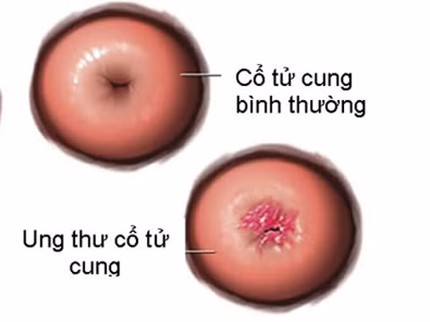 Virus HPV là thủ phạm chính gây ung thư cổ tử cung ở phụ nữ Virus HPV là thủ phạm chính gây ung thư cổ tử cung ở phụ nữ