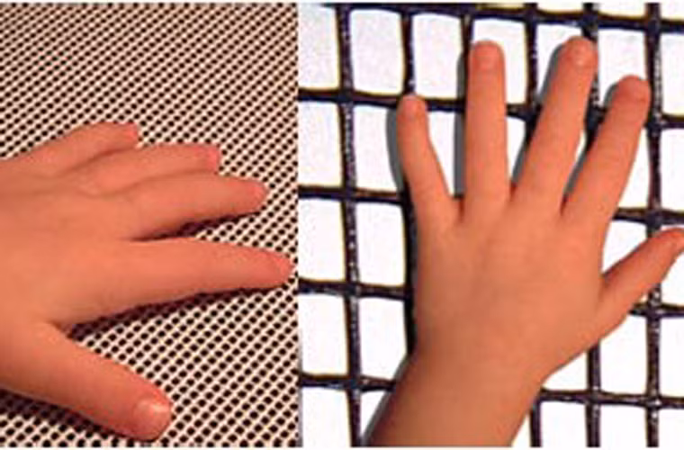 Kết quả là, những người sở hữu chiều dài ngón trỏ và ngón đeo nhẫn bằng nhau có 19% nguy cơ mắc bệnh. Tỷ lệ này tương đương với những người có ngón trỏ ngắn hơn ngón đeo nhẫn. Trái lại, những người có ngón trỏ dài hơn ngón đeo nhẫn giảm được tới 33% nguy cơ mắc bệnh.