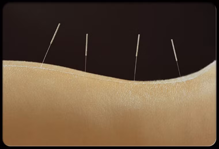 9 - Châm cứu là giải pháp tuyệt vời giúp giảm đau. Châm cứu tỏ ra rất hữu ích trong việc làm thuyên giảm các cơn đau. Bên cạnh châm cứu, tập yoga cũng có tác dụng hữu ích đối với người bệnh.