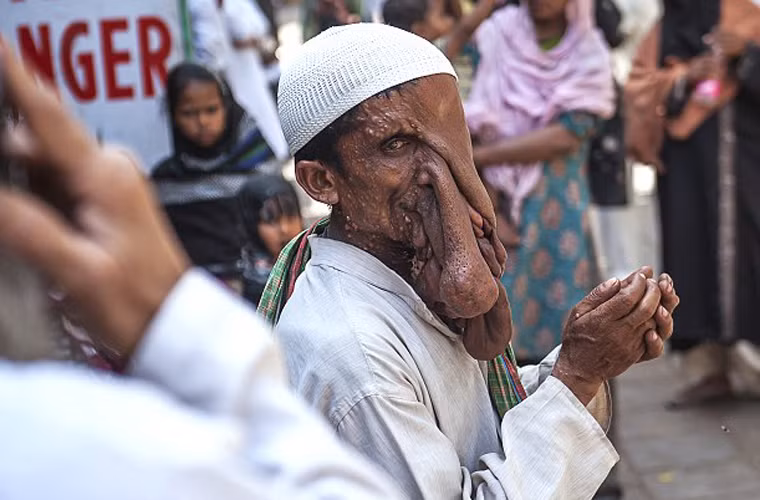 Ông bị mọi người xa lánh vì vẻ bề ngoài kì dị và buộc phải nghỉ học khi còn sớm. Sau khi kết hôn, với dáng vẻ khổ sở, Mannan còn phải lo lắng thêm cho vợ cùng bốn người con. Trong đó có hai trai và hai gái.