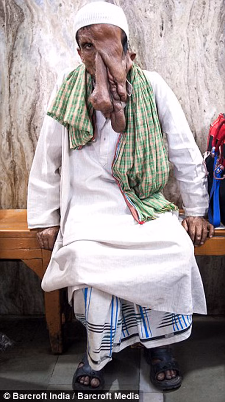 Điều duy nhất khiến tôi cảm thấy được an ủi là gia đình luôn đón nhận tôi với sự chân thành. Họ thường nói đùa rằng khuôn mặt tôi là sự sáng tạo của Thiên Chúa và chúng tôi không cần phải làm gì để thay đổi món quà này”.