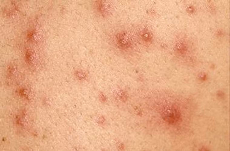 Tuy nhiên, nốt ban trên da có dạng chấm đỏ rải rác và không mọc theo bất kỳ quy luật nào. Khi bệnh lui thường hết sốt, ban bay nhanh không theo quy luật, không để lại dấu vết trên da, hạch trở về bình thường muộn hơn, thường sau một tuần.