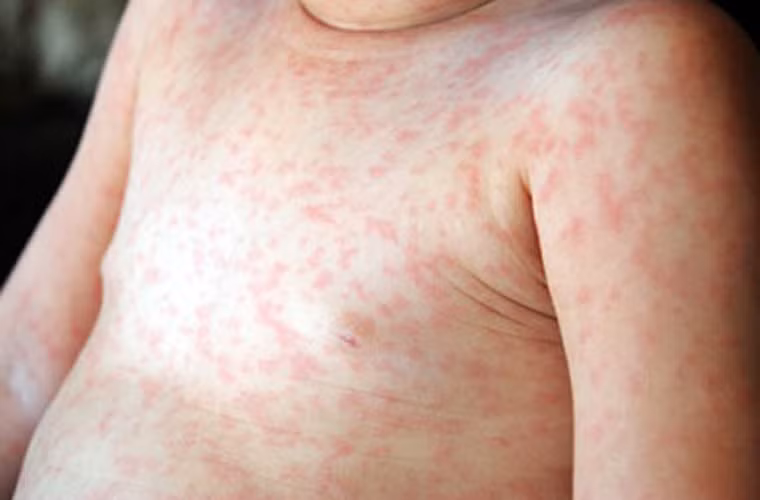 Về nguyên nhân. Sởi hình thành do siêu virus sởi gây nên. Trong khi đó, rubella bắt nguồn từ virus rubella. Cả hai bệnh đều lây lan qua đường hô hấp và có yếu tố dịch tễ và biểu hiện lâm sàng khá tương đồng. Tuy vậy mức độ biểu hiện triệu chứng và diễn biến lâm sàng, nhất là các biến chứng có thể có những biểu hiện không giống nhau.