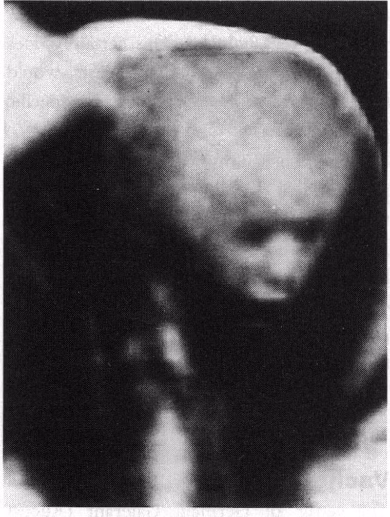 Do cảm thấy đau ở tinh hoàn, một anh chàng người Anh đi siêu âm để tìm hiểu căn nguyên vấn đề. Điều thú vị là hình ảnh khối u được tìm thấy ở vùng kín có hình ảnh giống hệt với gương mặt của anh. Rất may, đây là khối u lành tính, không gây ảnh hưởng nghiêm trọng.