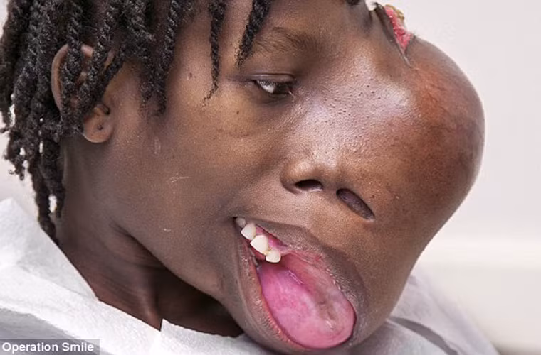 Ca phẫu thuật kéo dài trong vòng 12 giờ. Người trực tiếp tiến hành ca phẫu thuật, tiến sĩ William McGee cũng là giám đốc điều hành của tổ chức từ thiện cho biết, đây là khối u lớn nhất mà ông từng làm và khả năng hồi phục thị lực ở mắt trái cô bé là khá mong manh.