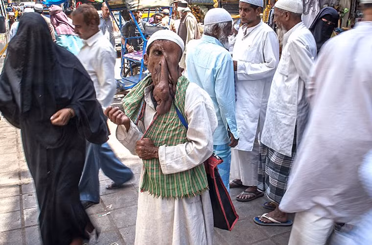 Sinh ra trong một gia đình túng quẫn, ngay từ bé Mannan đã mắc chứng neurofibromatosis với các khối u có kích cỡ lớn trên mặt.