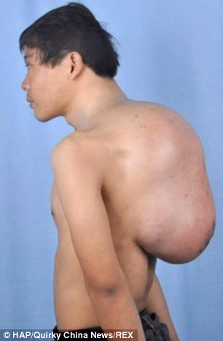 Sau khi rời viện, khối u không có chiều hướng ngưng phát triển khiến Xiao vô cùng đau khổ khi phải vác cả một “quả bóng” trên lưng. Nghiêm trọng hơn, khối u mở rộng hơn ra cả khu vực lưng và xương đòn.