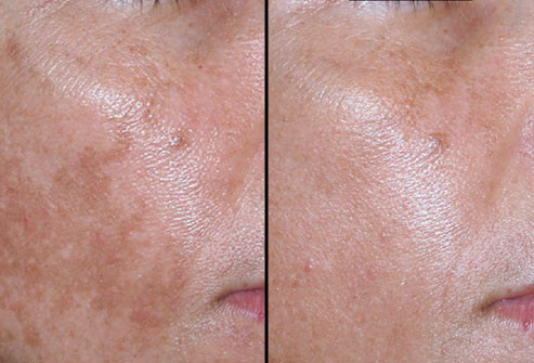 Điều trị Laser Nonablative cho da bị nám: Liệu pháp này đặc biệt hiệu quả trong điều trị nám, đốm nâu - thường xuất hiện trong thai kỳ. Hình ảnh này cho thấy một sự khác biệt rõ rệt ở khu vực má sau 4 lần điều trị bằng tia laser.