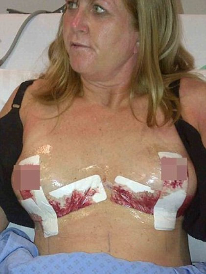 Nguyên nhân là chất silicon độn vào ngực bà quá khổ, lớn hơn so với sức chịu đựng của cơ thể nên đã gây ra hiện tượng rò rỉ từ từ và nổ bên trong cơ thể.